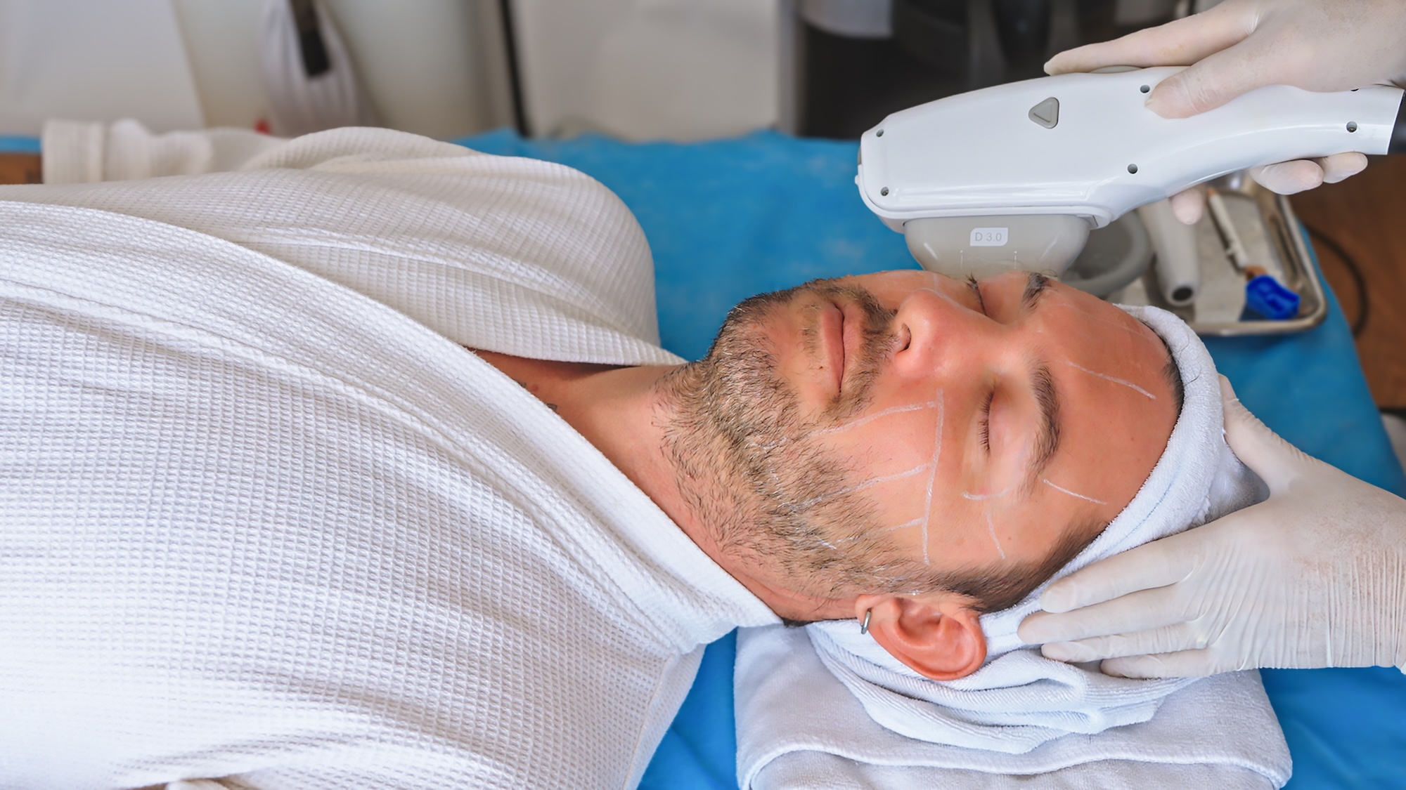 Receiving my own HIFU treatment